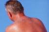 Sonnenbrand